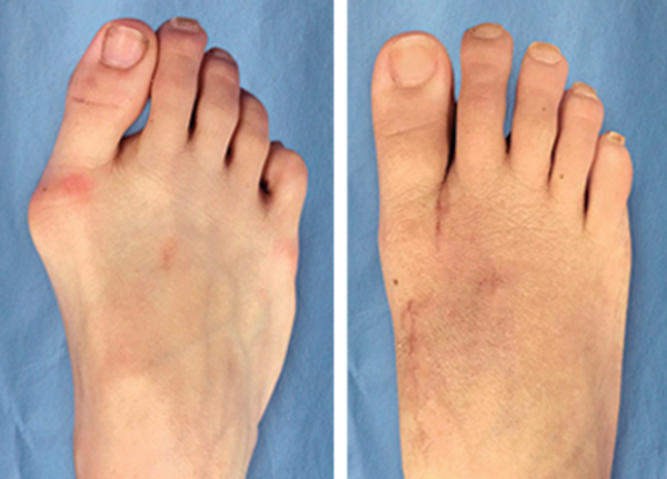 Lapiplasty 3D Bunion Correction