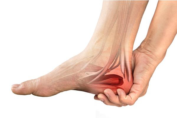 Plantar Fasciitis