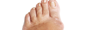 Bunions